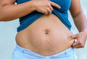 flacidez de vientre tras el parto